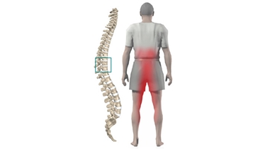 อาการปวดจากการกดทับเส้นประสาทแบบ สไปนอล สตีโนซิส