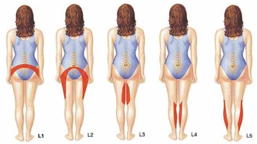 Herniated disc (or herniated disk)/ Bulging disc/Slipped dis